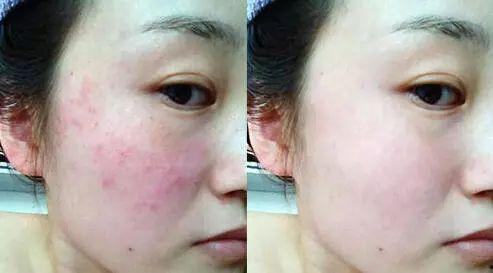 有明星得皮炎的吗,揭秘明星皮炎背后的真相