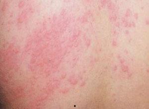 吃瓜过敏起湿疹图片